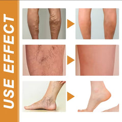 Turmeric Vericose Vein Relief Spray
