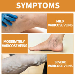 Turmeric Vericose Vein Relief Spray